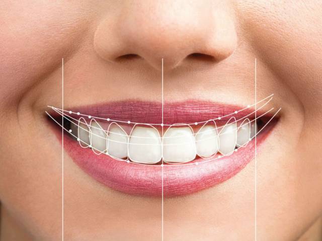 Smile Design & Zahnkronen  Antalya 